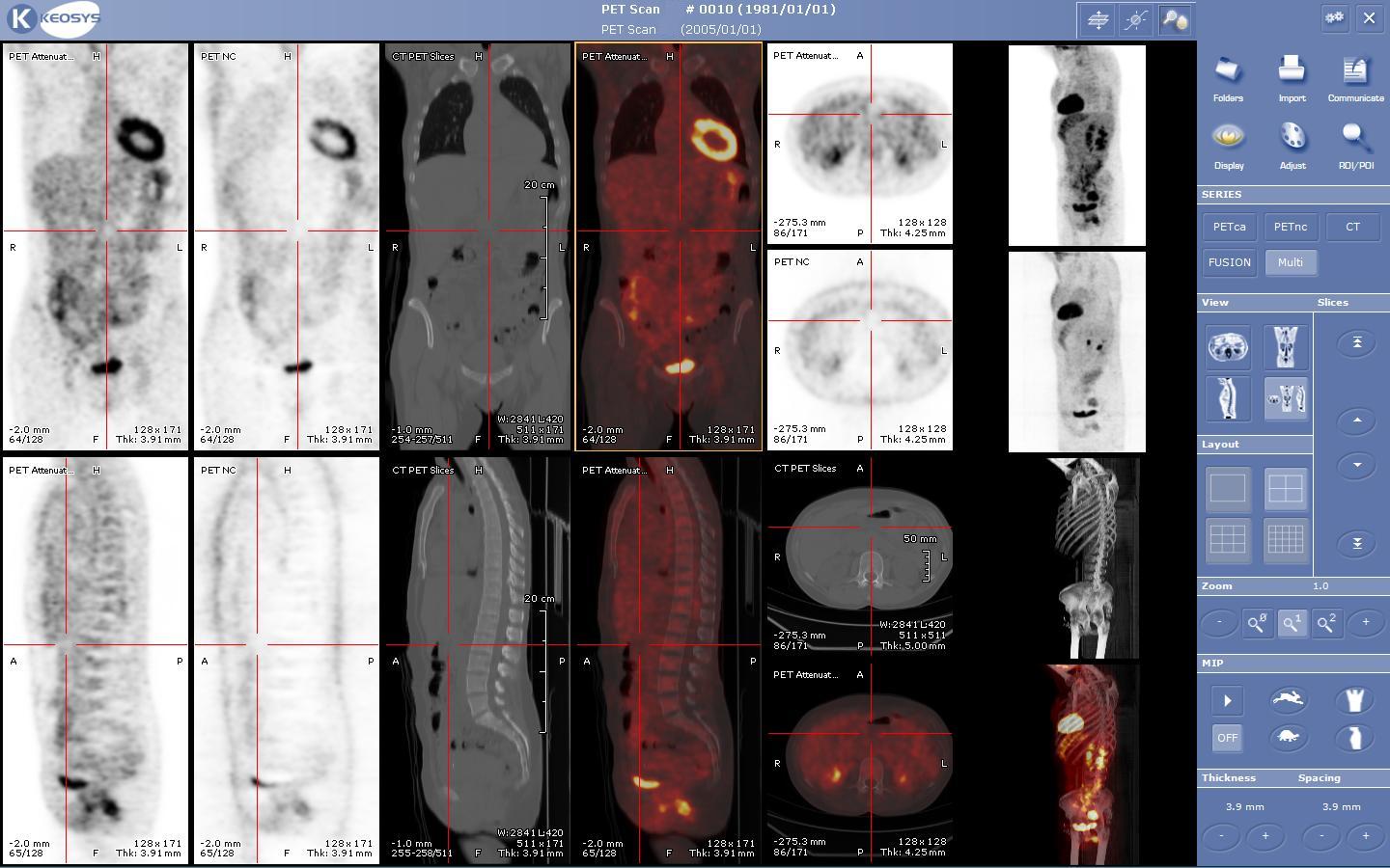 Nuclear medicine PET CT viewer screenshot