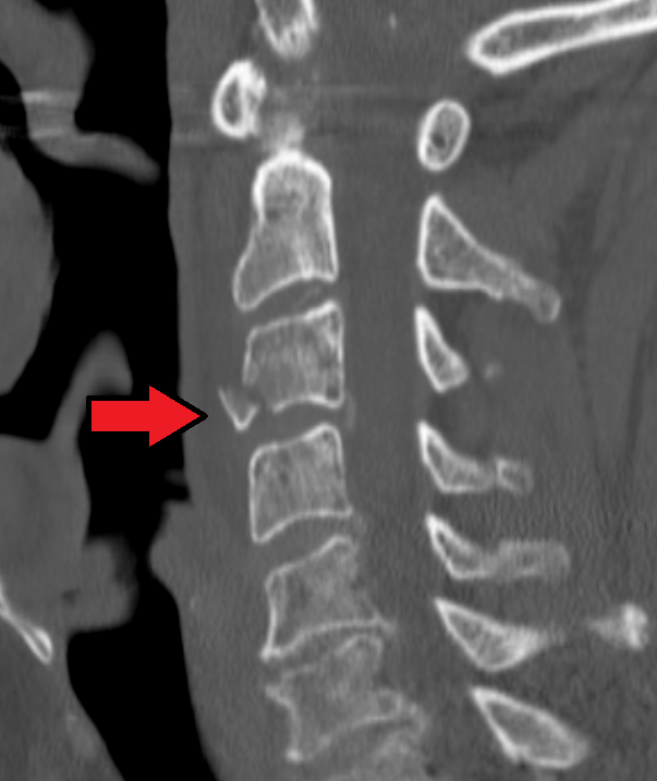 CT image of marked teardrop fracture at C3