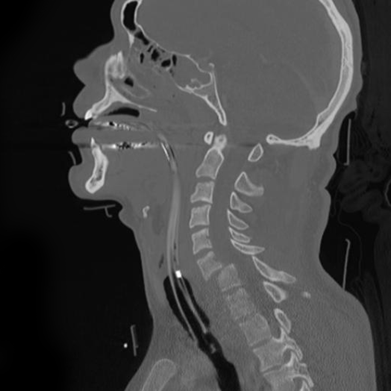 CT image of cervical fracture dislocation at C6-C7