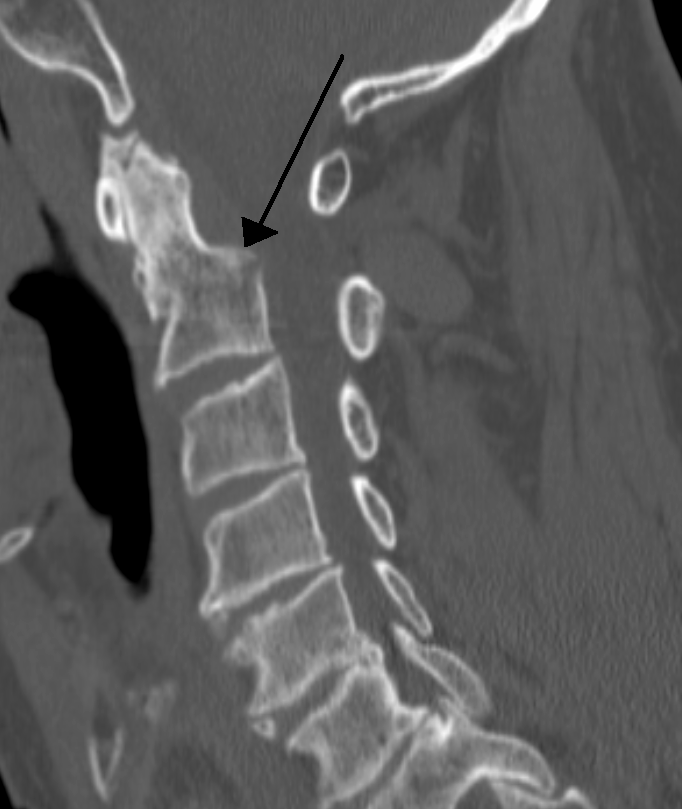 CT image of a dens fracture