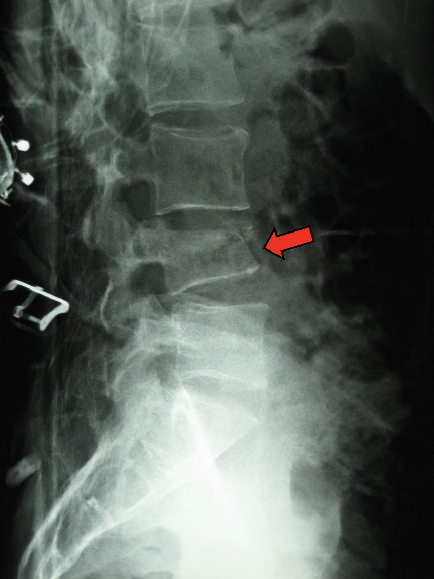 Radiograph showing L4 compression fracture